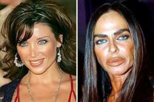 Worst Plastic Surgery Fails 7