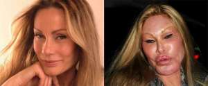 Worst Plastic Surgery Fails 8